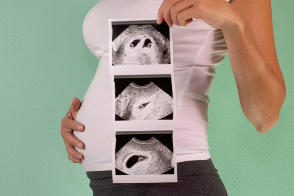 First Trimester (NT-NB) Scan